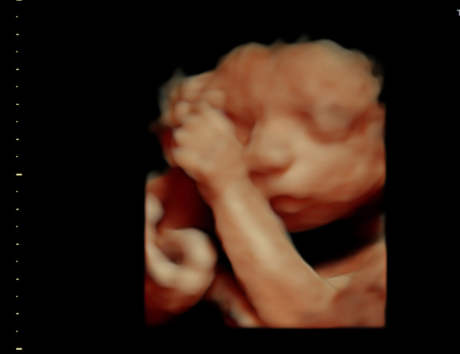 3D ultrasound image at 25 weeks